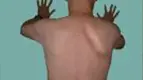 winged-scapula.webp