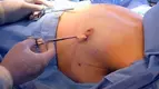 Gynecomastia-Surgery.webp