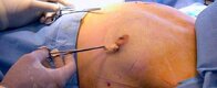 Gynecomastia-Surgery