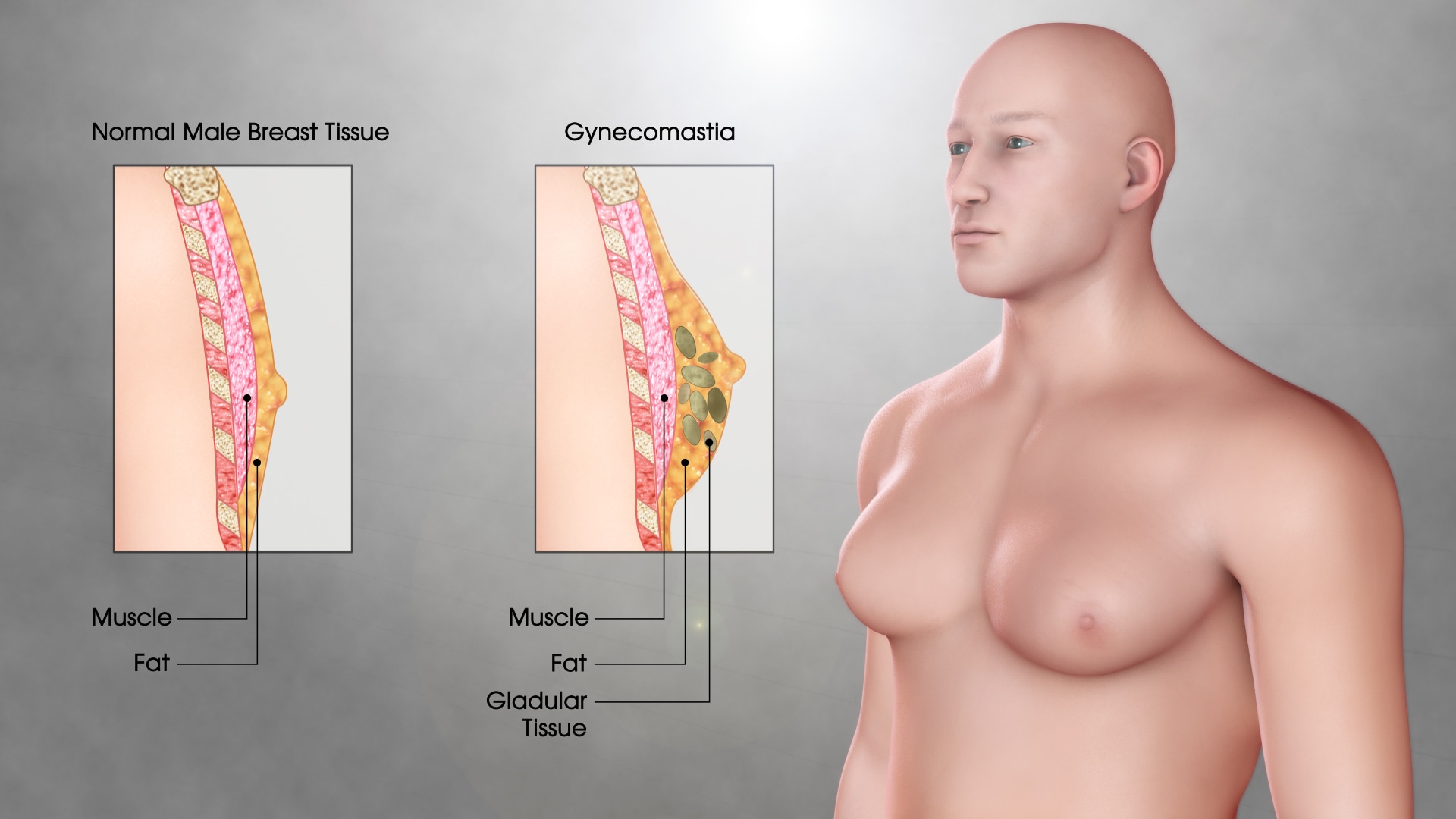 Gynecomastia.jpg